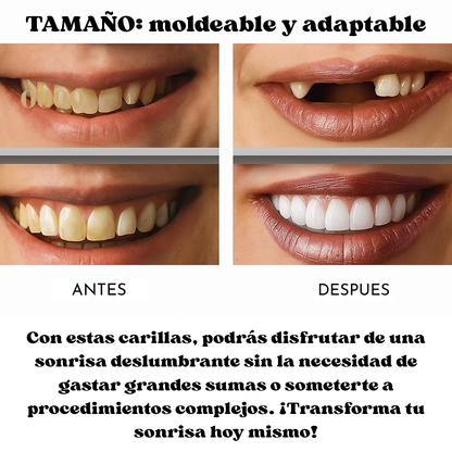 Carillas Dentales Instantáneas Sonrisa 360™ Sin dentista.