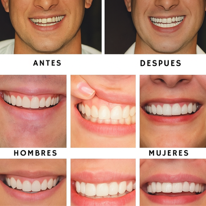 Carillas Dentales Instantáneas Sonrisa 360™ Sin dentista.